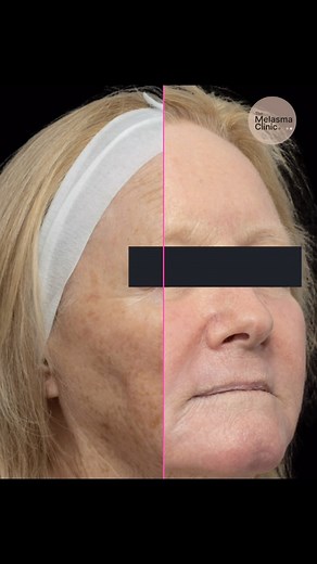 Dr Davin Lim & Dr Van Park on Instagram: "🔫Light CO2 laser resurfacing using the Tetra Pro Deka, one session . 👉CO2: is still one of the best wavelengths to address photodamage, wrinkles & non-melasma pigmentation . 👉Skin types: 1-2 ideally, however with modifications to settings (beam profile, density, pulse duration) we can safely treat up to skin type V (darker skin) . ⏱️Treatment time: Less than 8 minutes . 📆Recovery: 3 to 10 days . 😎Dr Davin Lim Dermatologist Sydney | Brisbane 🇦🇺 . #