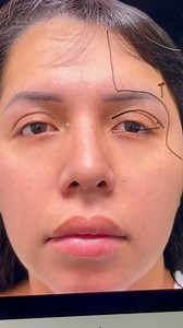 2.2K views · 76 reactions | Plan de cirugía: RITIDECTOMIA ENDOSCOPICA...