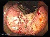 Gastric Adenocarcinoma With Varices - Endoscopy (4 of 8) • Video • MEDtube.net