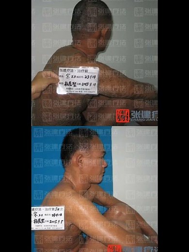 Severe lamellar ichthyosis skin change after treatment #ichthyosistreatment #ichthyosisvulgaris