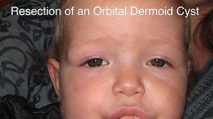 Orbital Dermoid Tumor Removal