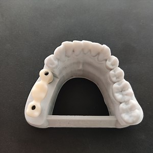 [Hot Item] Custom CAD Cam Screw-Retained 3-Unit Implant Zirconia Crowns Bridge Titanium Abutment