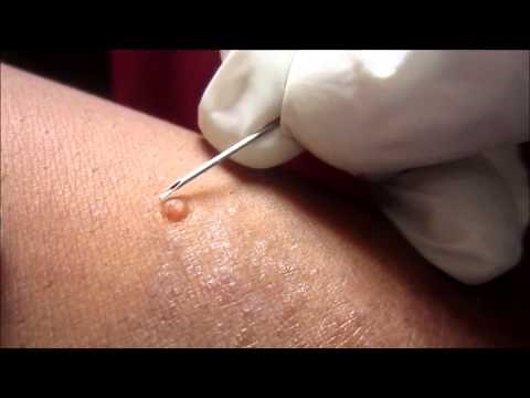 Removing H P Body From Molluscum Contagiosum