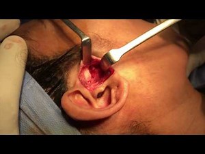 Eminectomy - for recurrent TMJ Dislocations