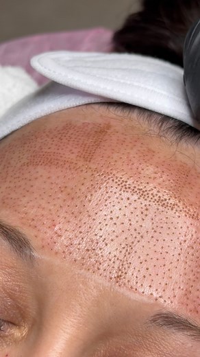 Smooth, refined, and still you. ✨👑 Forehead lines starting to bother you — but Botox just isn’t your thing? We get it.🙌 Not every woman wants to freeze her expressions or go down the injectables path, especially when there’s a natural, chemical-free, and toxin-free alternative that delivers visible results without compromising your authenticity.🌿 ✨ Fibroblast is perfect for women in their 40s who are noticing the first signs of aging, fine lines, subtle wrinkles, creasing skin and want real, 