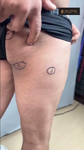 Lipoma Removal