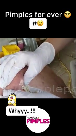 #pimple #medical #horror #blackhead #bigpimple #pimpleremoval #disgusting #pimplepop #cystexplosion #squeeze #squeezeyuk #skincare #acnetreatment #acne #pimples #satisfying #whiteheads #abscess #verysatisfying #cyst