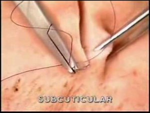 SUBCUTICULAR skin suturing