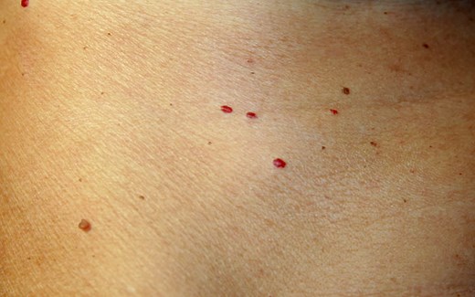 What Causes Red Spots On Skin & How To Treat Them