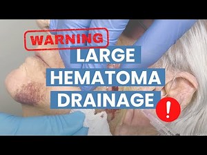 A blood-filled zit? (Hematoma Drainage) | CONTOUR DERMATOLOGY