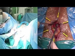 AdVance XP male sling implantation