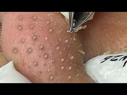 Satisfying With Loan Nguyen Spa Video (#061) #acnetreatment