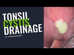 TONSIL DRAINAGE - How To Drain a Peritonsillar Abscess