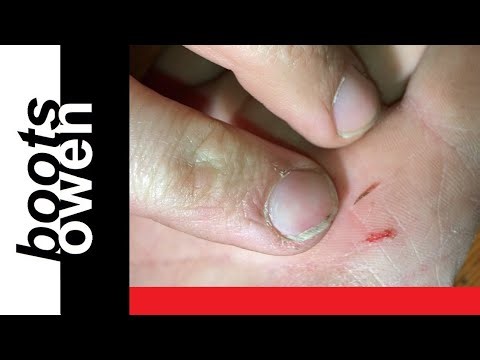 Huge splinter in my hand easily removed with pin NO PAIN, quick extraction!