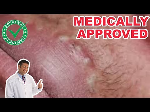 Get Rid of BLACKHEADS on your Lips [Dermatologist Approved]