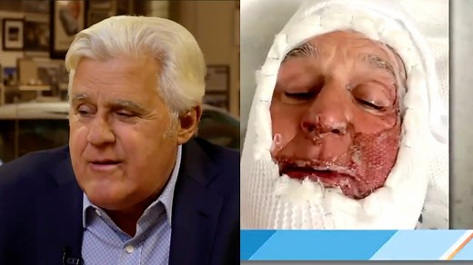 Jay Leno details how his face caught on fire and shares never-before-seen photos of his horrific burn injuries. | Extra