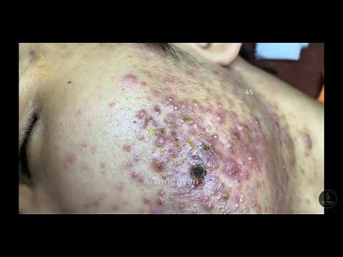 ACNE TREATMENT FOR Mạnh past 2 (45) | Loan Nguyen