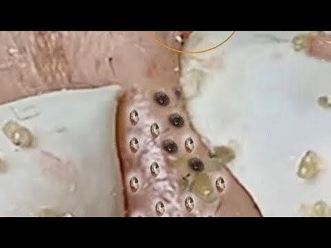 Pimple Popping 2020 Video #45| Blackheads removal, Acne removal, acne treatment