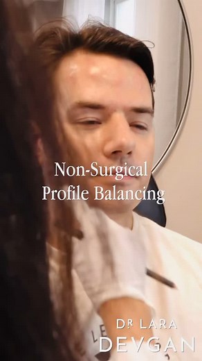 For this handsome patient, I enhanced the jawline and chin with a tailored approach to structural balance and masculine refinement. Using injectable fillers, I emphasized angularity and projection—defining the lower face while maintaining harmony with his natural features. The result is a stronger, more sculpted profile that conveys confidence and character without appearing overdone. Subtle, strategic augmentation can sharpen facial contours and restore proportion in a way that feels inherently