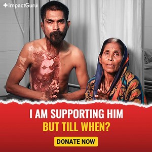 “Severe 3rd degree burn wounds from an accident are destroying my son Bharat’s life. A small domestic fire suddenly grew out of control and caused him serious burns. He lives in constant pain that makes his skin itch. He is unable to work due to this condition. At an age where I need his utmost support, I am trying all I can to keep him comfortable! He needs an urgent surgery to recover and live a normal life again. My only wish at this stage of my life is to see that my son is healthy so that h