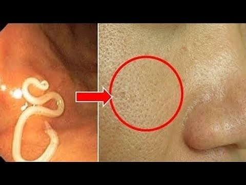 80% People Have Mites On Their Face! Kill All Demodex Mites On Your Face Fast & Naturally At Home!