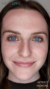 Finally, a luxury clean skincare & award-winning beauty tools that can do all that at home!: - plump lips - erase eye & neck lines - improve skin texture (makeup sits better) - even out the tone of all colors of skin - rejuvenate hands - reduce acne & inflammation - extend longevity of Botox & fillers Developed and funded by Masha Amelina, Cosmetic Medicine PA-C, to help You maintain your beauty. Transform your skin instantly & long term! | MesoLyft micro-needling skincare