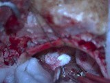 Large Vestibular Schwannoma, Retrosigmoid Approach, Gross Total Resection • Video • MEDtube.net