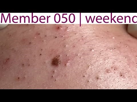 Acne Treatment Huong Da Nang# 050 | weekend | 2023