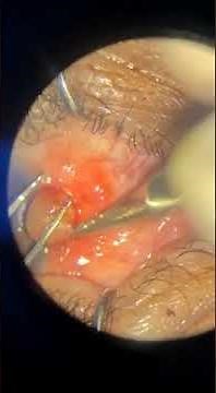 Excision of conjunctival inclusion cyst