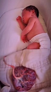 LOTUS BIRTH:🤱🏽🍃 A lotus birth is the practice of leaving the umbilical cord uncut after childbirth so that the baby is left attached to the placenta until the cord naturally separates at the baby's navel (aka belly button).🤱🏾 Following birth, the placenta is simply put in a bowl or quickly wrapped in absorbent toweling and placed near the mother & baby.🤱🏽🪹 During a lotus birth, the birth team steps back primarily for an hour or so to allow for bonding between mother & baby. It is only af