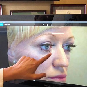 We are seeing an increasing number of patient’s come to us to fix problems stemming from having the wrong fillers injected around the eye area. Take a look at this patient who came to see us because she was wrongly injected with #Juvederm. This caused chronic swelling to her under eye area. We dissolved the filler over time and then treated her with a co2 Laser resurfacing treatment around the eyes to smooth and tighten the eye area. Note the smooth transition and natural contour to her eyes 👀.