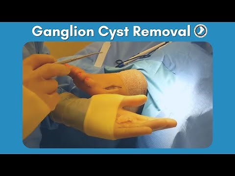 Ganglion Cyst Removal