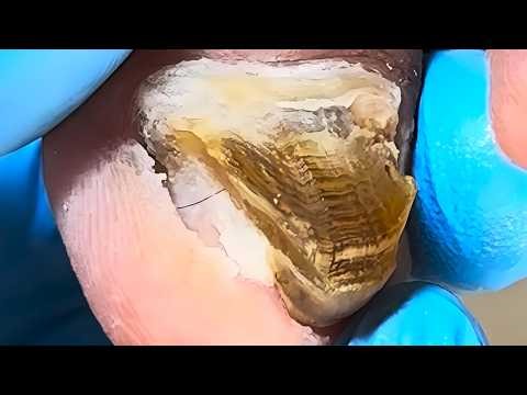 Triangular-Shaped Onychomycosis Nails, Very Thick And Black, Growing Abnormally【Xue Yidao】