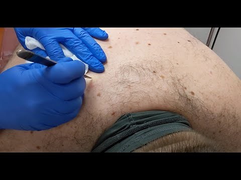 Never Let A Cyst Go!! Procedure of The Complete Removal of a Cyst