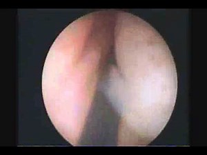 Optical Internal Urethrotomy-OIU operated by Dr. Aditya Pradhan/ Dr. YPS Rana at BLK Hospital