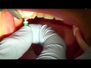 Root Canal Treatment {My Top 5 Rubber Dam Clamps and a 1 Step Endo}
