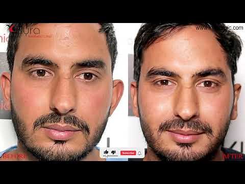 Otoplasty, Otoplasty Recovery, Otoplasty before and after pictures | Dr. Vikas Gawri