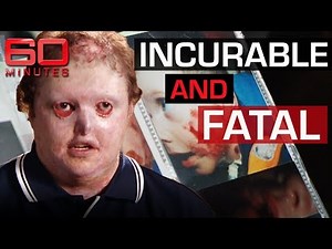 Rare and mysterious disease causes skin to fall off | 60 Minutes Australia