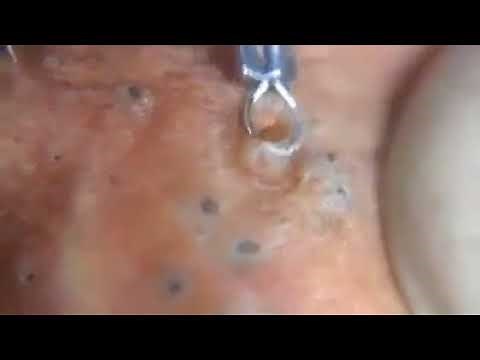 Smerige mee-eters & puisten uitknijpen