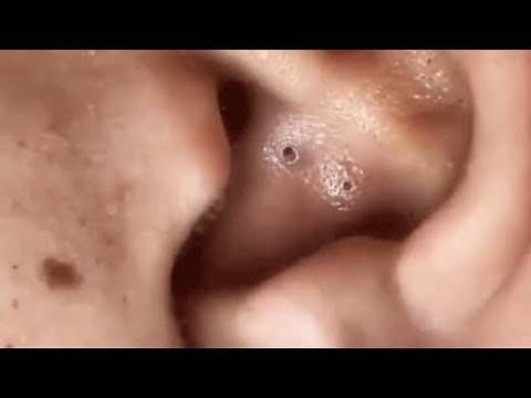 TOP OF BLACKHEADS REMOVAL FROM THE EAR 😨 #3 #relaxing #blackheads