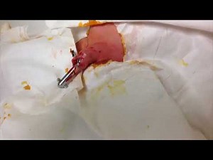 Circumcision Gomco Clamp Technique