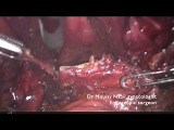 Complex Hysterectomy with Recto Vaginal Endometriosis • Video • MEDtube.net