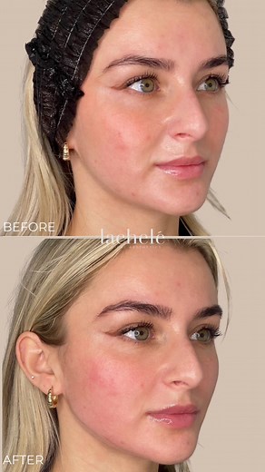 ✨ The 8-Point Lift Technique💉 Our Medical Providers use this technique to lift, sculpt, and restore volume in 8 key areas of your face: 📍 Cheekbones – Hello, instant definition! ✨ 📍 Under-Eyes – Bye-bye, tired look! 👋😴 📍 Smile Lines – Smooth & youthful vibes! 😊 📍 Mouth Corners – No more sad expressions! 📍 Jawline – Snatched & sculpted! 💖 📍 Chin – Balanced, beautiful profile! 😍 📍 Pre-Jowl Area – Say goodbye to sagging! 📍 Temples – Plump & lifted perfection! 🔥 Results are natural an