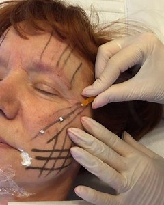 Thread Lift PDO 👉🏼 £399 face or £450 face & neck 👌🏼Thread Lift are one of the most popular and highly effective non-surgical means to lift & tighten loose, sagging skin tissues as well dissolve small areas of fat on the lower face and body. PDO is a synthetic fibre widely used in areas of medicine such as general surgery and cardiology. In aesthetics, the threads help to lift sagging skin as well as stimulate new collagen - your own natural collagen. Another interesting effect of the threads