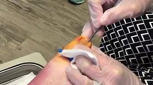 13K views · 42 reactions | The recovery time is usually only a day, so don't leave your ingrown toenail untreated...and just say no bathroom surgery! YIKES! Read about ingrowns >> https://bit.ly/2KBFKBn | Lexington Podiatry | Facebook