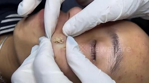 Dermatologist removes 5 years old of giant acne hidden under man's face