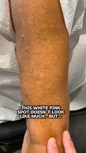 This white-pink patch on the arm doesn’t look like much. Under dermoscopy? ➡️ Invasive melanoma. Melanoma is a chameleon, it can look like irritation, eczema, a pale scar-like patch, or nothing” at all. And here’s the issue. There is a real gap in skin cancer screening: It’s not just “naked eye vs dermoscopy.” It’s selective dermoscopy non-standardized dermoscopy training. That’s how melanomas get missed: They look normal to the eye, so they don’t get a second look. Or dermoscopy is used, but th