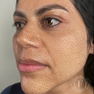 Full Plasma Facelift✨ This full coverage treatment takes 8-10 weeks to fully heal🤍 What is fibroblast skin tightening? . Plasma Skin Tightening is a revolutionary, non-invasive alternative treatment to traditional surgery. The treatment helps eliminate excessive tissue that causes sagging skin, unwanted wrinkles, stretch marks and even diminish scarring. Book your consultation today!✨ 𝗧𝗼 𝗯𝗼𝗼𝗸 𝗮𝗻 𝗮𝗽𝗽𝗼𝗶𝗻𝘁𝗺𝗲𝗻𝘁 𝘄𝗶𝘁𝗵 𝗺𝗲 𝗰𝗹𝗶𝗰𝗸 𝘁𝗵𝗲 𝗹𝗶𝗻𝗸 𝗶𝗻 𝗺𝘆 𝗯𝗶𝗼 𝗼𝗿 𝗱𝗺 �