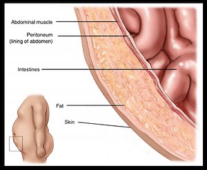 What is a Hernia - California Hernia Specialists