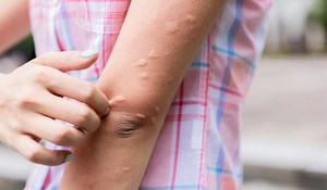 Qué remedios caseros debes usar contra la picaduras de mosquitos